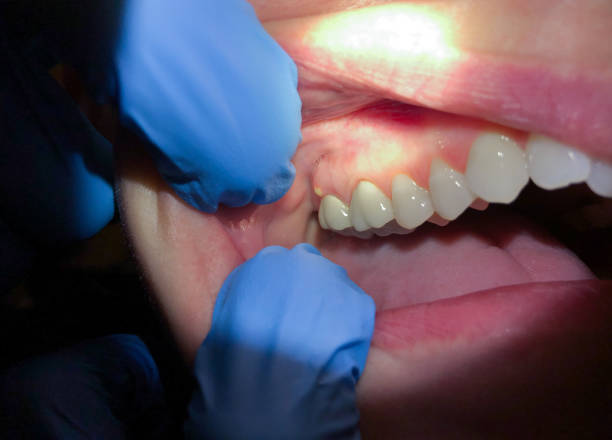 Best Emergency Tooth Extraction in Prince Frederick, MD